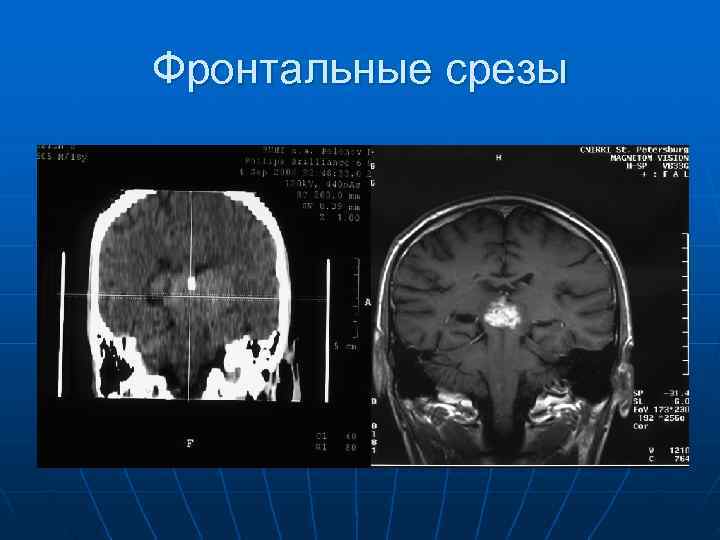 Фронтальные срезы 