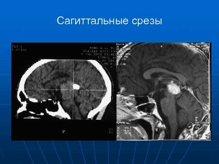 Сагиттальные срезы 