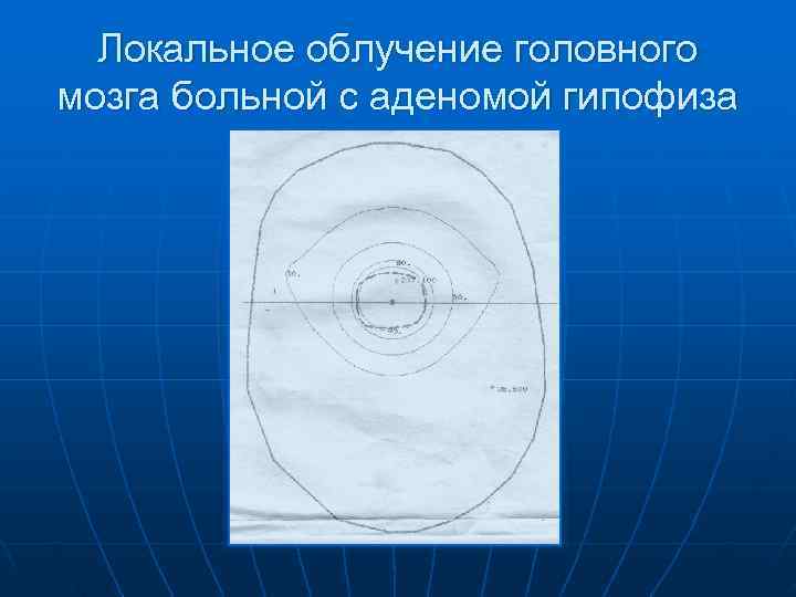  Локальное облучение головного мозга больной с аденомой гипофиза 