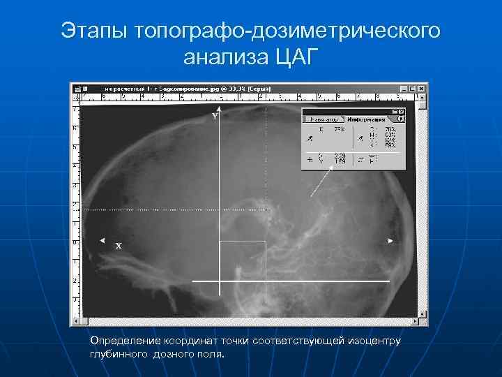 Этапы топографо-дозиметрического  анализа ЦАГ  Определение координат точки соответствующей изоцентру  глубинного дозного