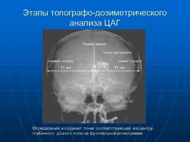 Этапы топографо-дозиметрического  анализа ЦАГ  Определение координат точки соответствующей изоцентру  глубинного дозного