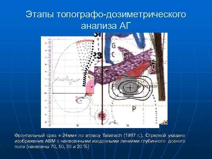   Этапы топографо-дозиметрического    анализа АГ Фронтальный срез «-24 мм» по