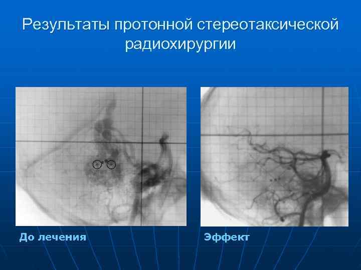Результаты протонной стереотаксической   радиохирургии До лечения  Эффект 