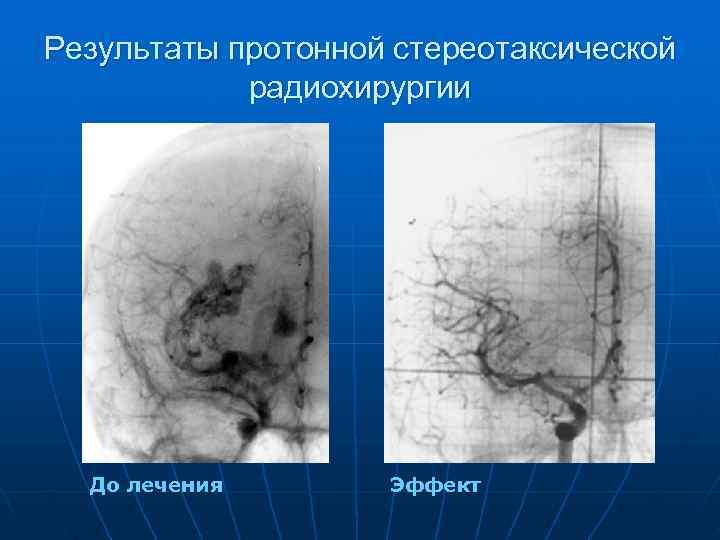 Результаты протонной стереотаксической   радиохирургии  До лечения  Эффект 