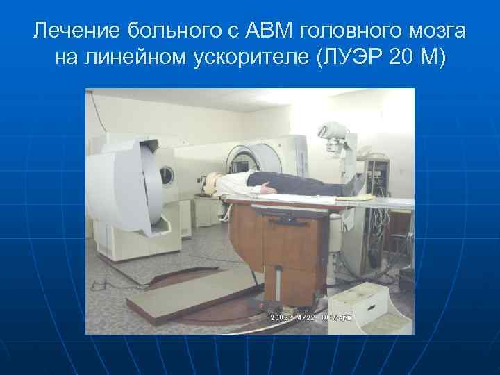 Лечение больного с АВМ головного мозга на линейном ускорителе (ЛУЭР 20 М) 