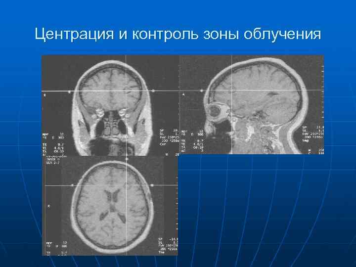 Центрация и контроль зоны облучения 
