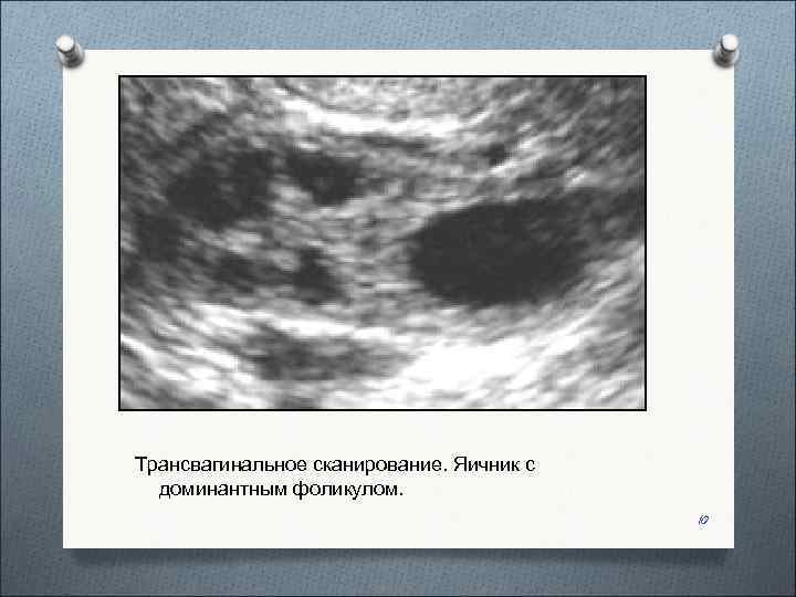 Трансвагинальное сканирование. Яичник с  доминантным фоликулом.     10 