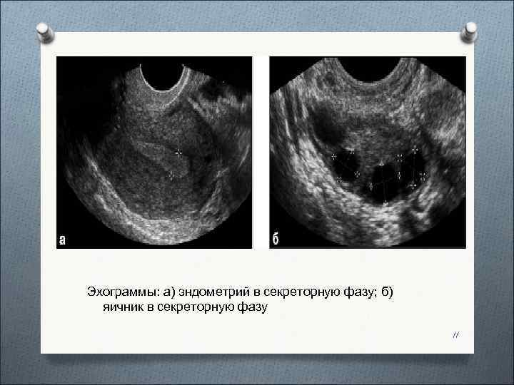 Эхограммы: а) эндометрий в секреторную фазу; б)  яичник в секреторную фазу  