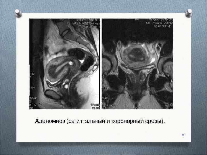 Аденомиоз (сагиттальный и коронарный срезы).     18 