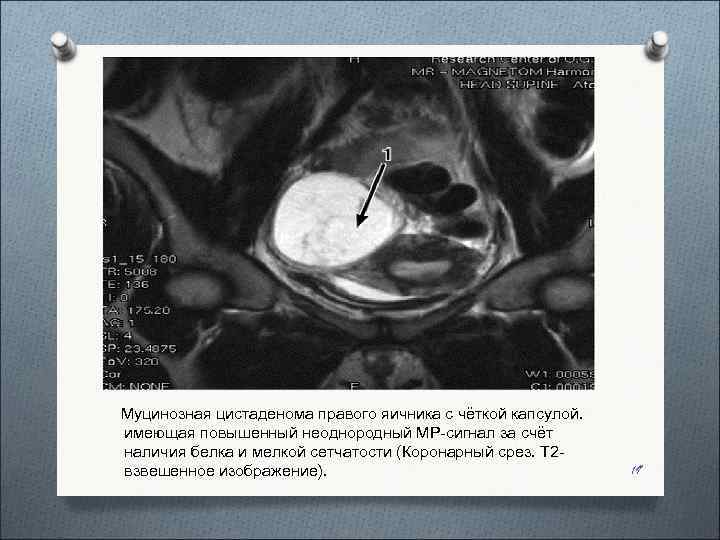   Муцинозная цистаденома правого яичника с чёткой капсулой.  имеющая повышенный неоднородный МР-сигнал