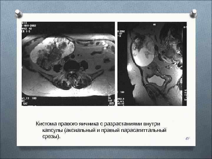 Кистома правого яичника с разрастаниями внутри  капсулы (аксиальный и правый парасагиттальный  срезы).