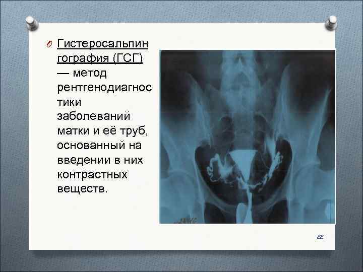 O Гистеросальпин гография (ГСГ)  — метод  рентгенодиагнос тики  заболеваний  матки