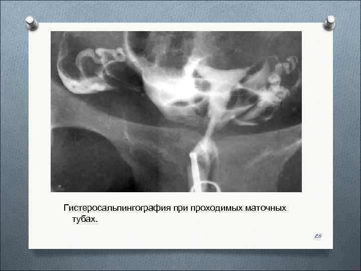  Гистеросальпингография при проходимых маточных тубах.     26 