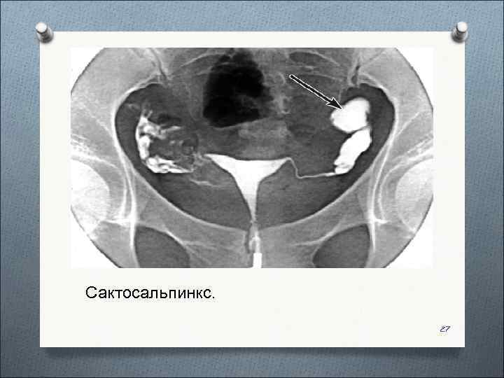 Сактосальпинкс.     27 