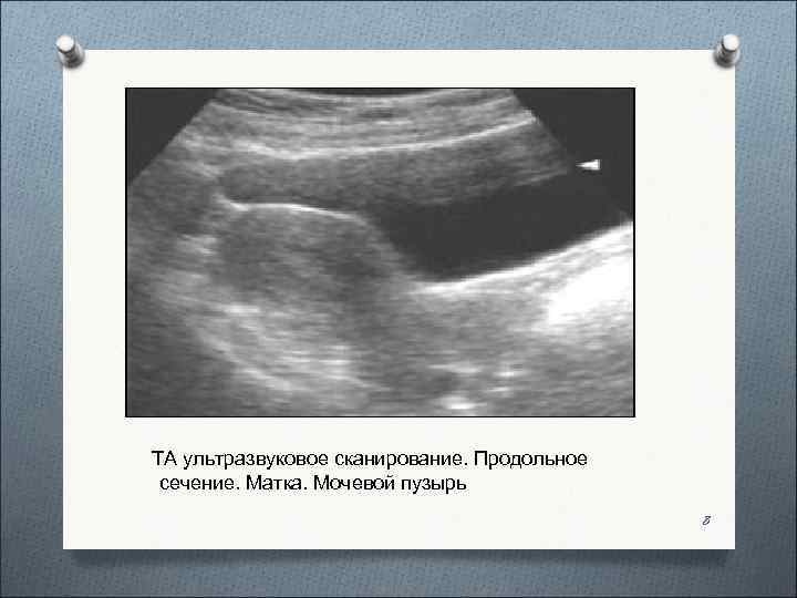   ТА ультразвуковое сканирование. Продольное сечение. Матка. Мочевой пузырь    
