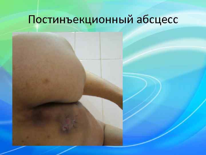 Постинъекционный абсцесс 