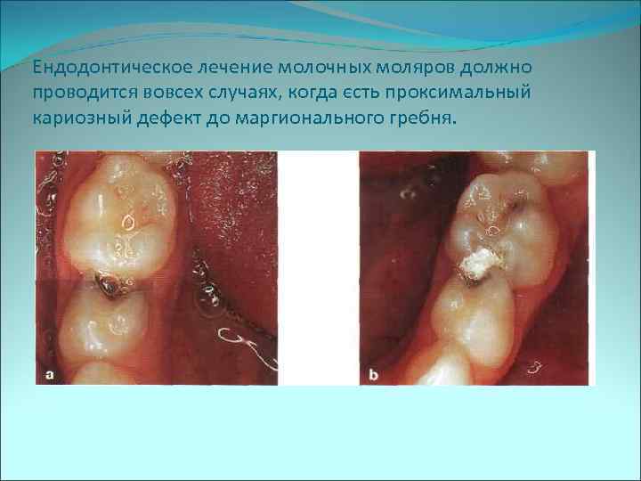 Ендодонтическое лечение молочных моляров должно проводится вовсех случаях, когда єсть проксимальный кариозный дефект до