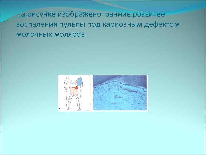 На рисунке изображено ранние розвитее воспаления пульпы под кариозным дефектом молочных моляров. 