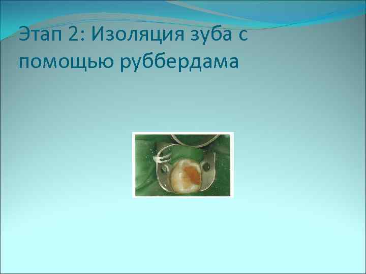 Этап 2: Изоляция зуба с помощью руббердама 