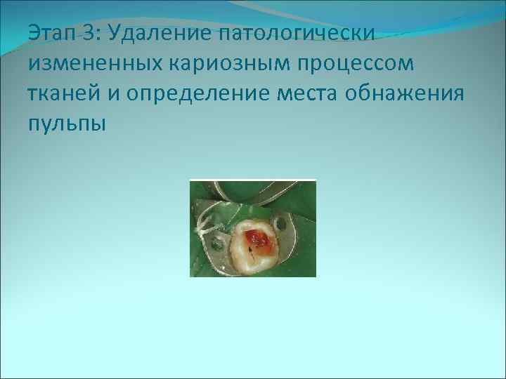 Этап 3: Удаление патологически измененных кариозным процессом тканей и определение места обнажения пульпы 