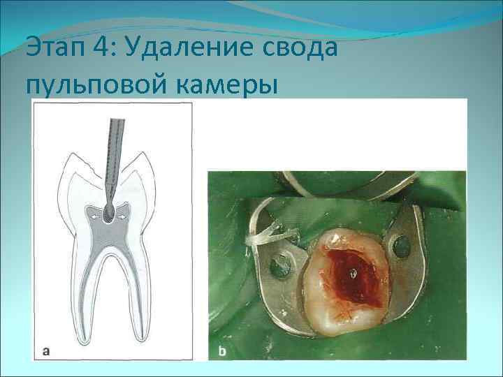 Этап 4: Удаление свода пульповой камеры 