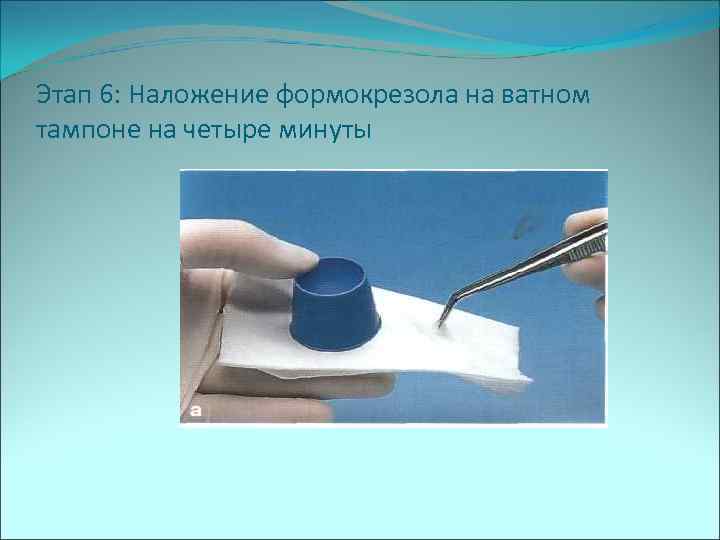 Этап 6: Наложение формокрезола на ватном тампоне на четыре минуты 