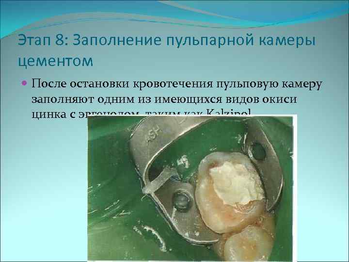 Этап 8: Заполнение пульпарной камеры цементом  После остановки кровотечения пульповую камеру  заполняют