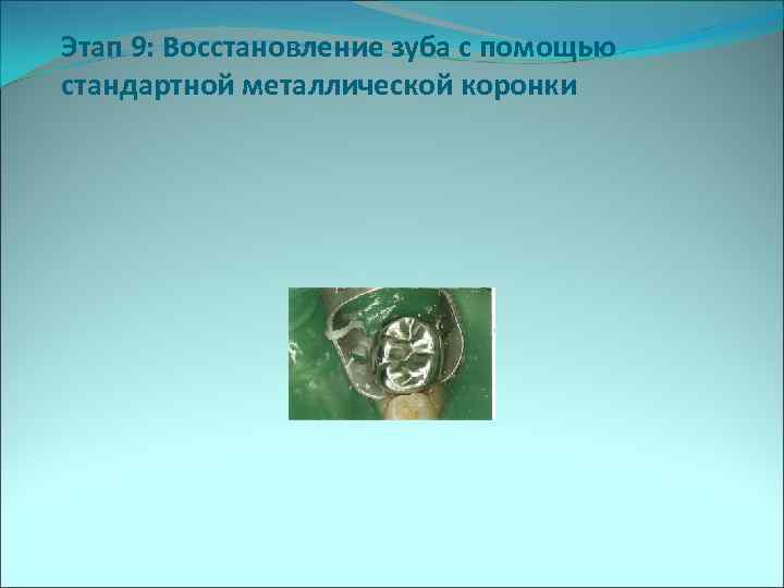 Этап 9: Восстановление зуба с помощью стандартной металлической коронки 