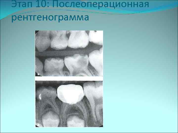 Этап 10: Послеоперационная рентгенограмма 