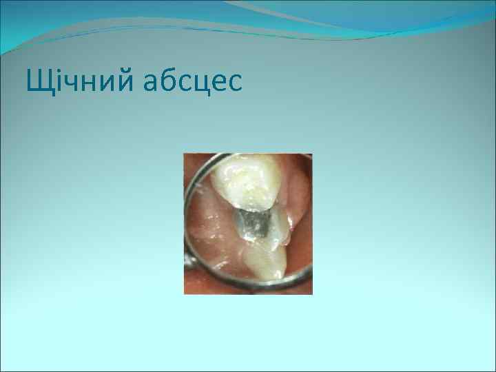 Щічний абсцес 