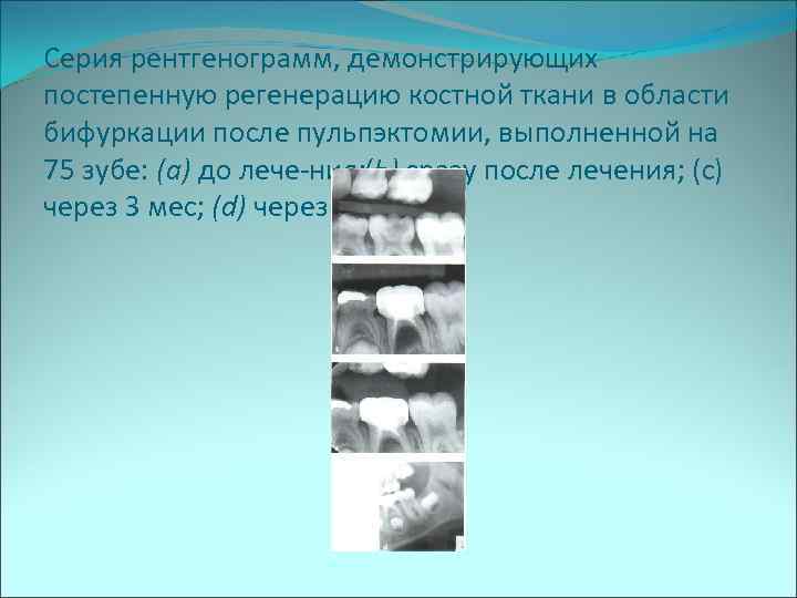 Серия рентгенограмм, демонстрирующих постепенную регенерацию костной ткани в области бифуркации после пульпэктомии, выполненной на