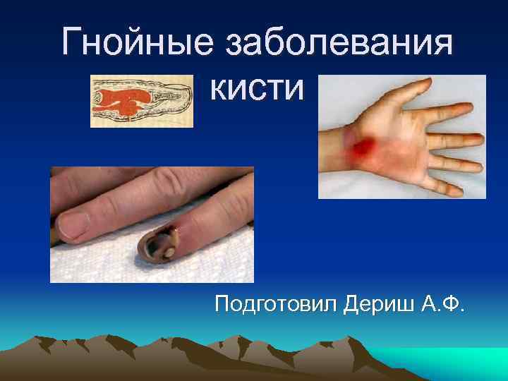 Гнойные заболевания   кисти  Подготовил Дериш А. Ф. 