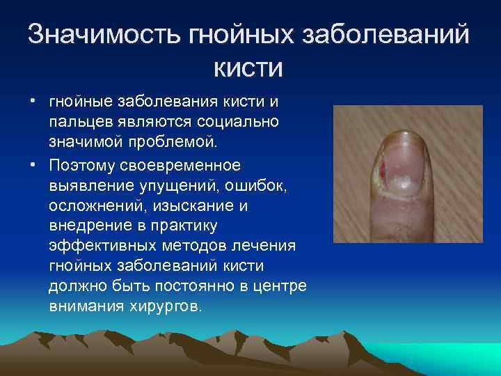 Значимость гнойных заболеваний    кисти • гнойные заболевания кисти и  пальцев