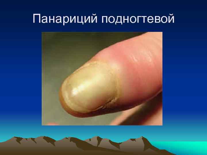 Панариций подногтевой 