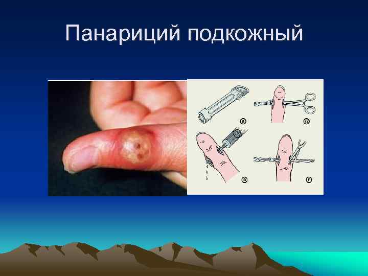 Панариций подкожный 