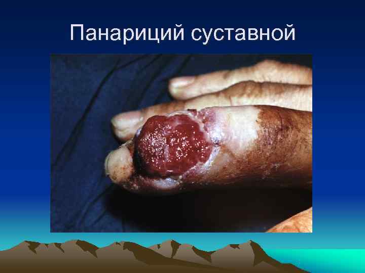 Панариций суставной 