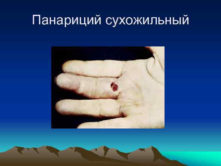 Панариций сухожильный 