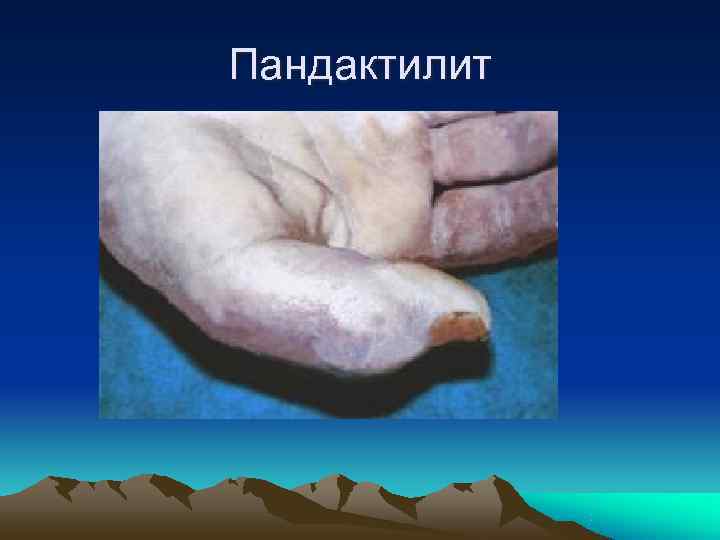 Пандактилит 