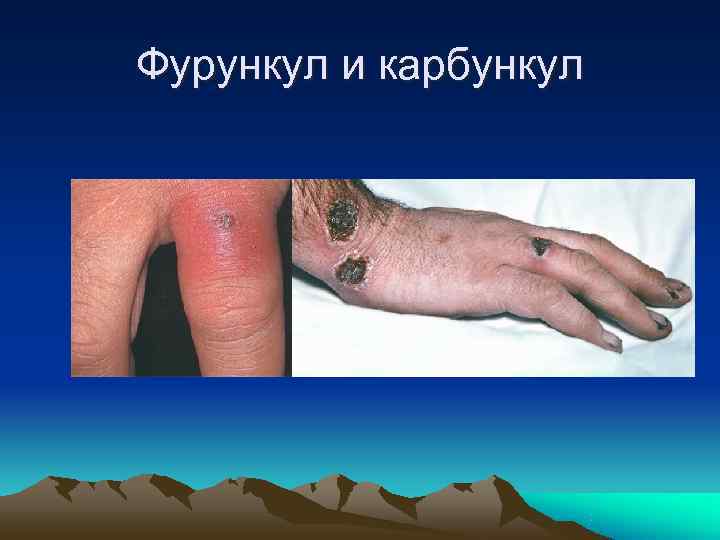 Фурункул и карбункул 