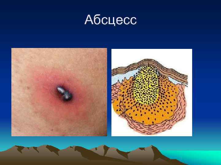 Абсцесс 