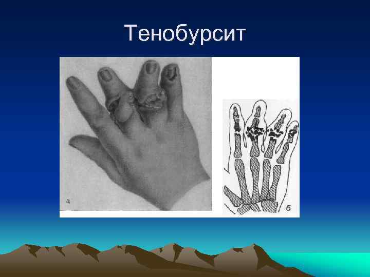 Тенобурсит 