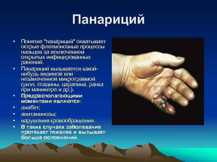      Панариций •  Понятие 