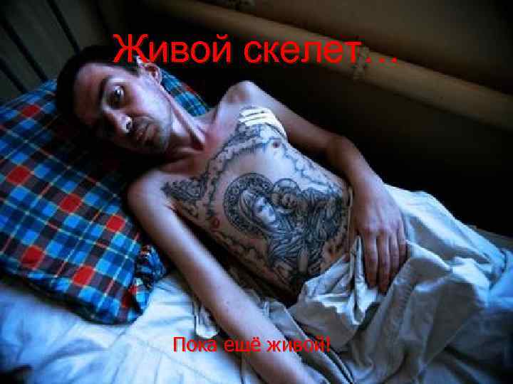 Живой скелет…  Пока ещё живой! 