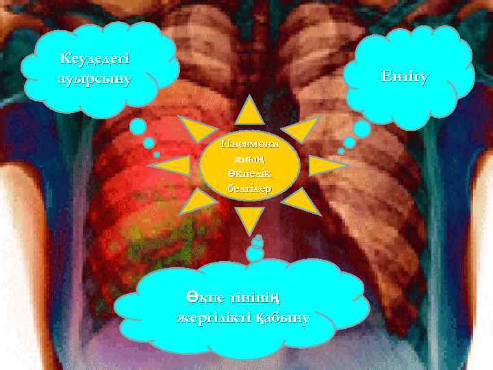 Кеудедегі ауырсыну    Ентігу     Пневмони   