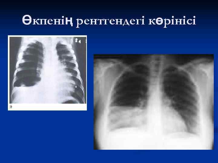 Өкпенің рентгендегі көрінісі 