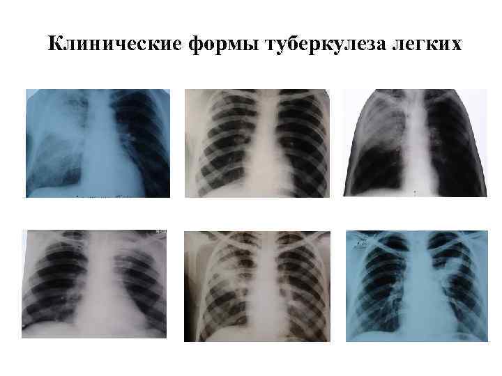 Клинические формы туберкулеза легких 