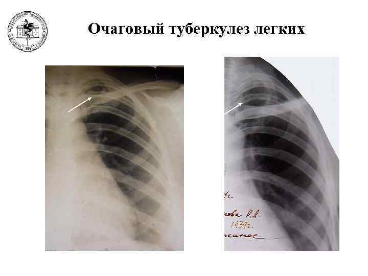 Очаговая форма туберкулеза. Очаговый туберкулез рентген.