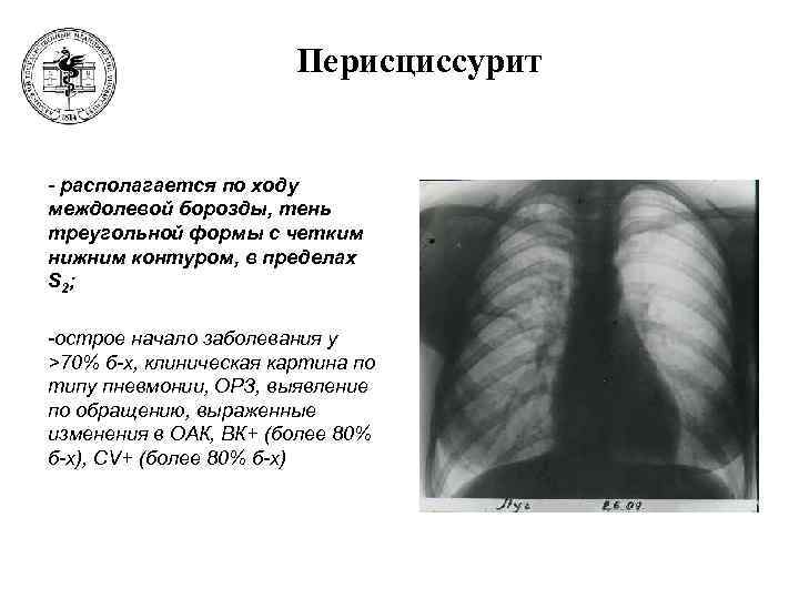 Перисциссурит рентген картина