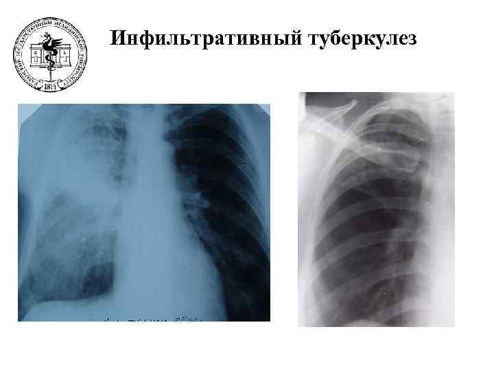 Инфильтративный туберкулез 
