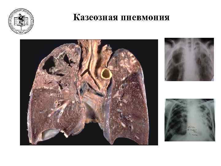 Казеозная пневмония фото